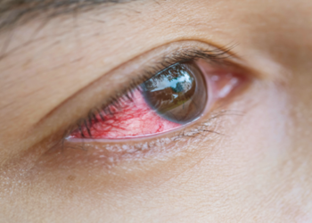Mengapa Tidak Boleh Memakai Softlens Terlalu Lama?