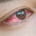 Mengapa Tidak Boleh Memakai Softlens Terlalu Lama?