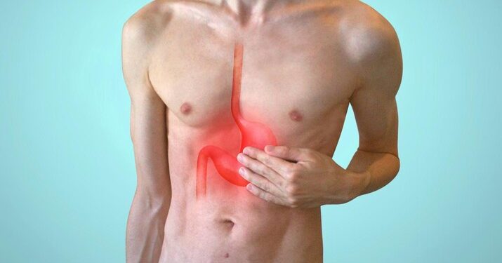Puasa dan GERD: Mitos dan Fakta dari Sudut Pandang Medis