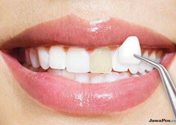 Mengenal Kerugian Veneer Gigi Abal-abal: Bahaya. Veneer gigi adalah salah satu teknik kosmetik yang populer untuk