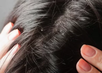 Mengapa Rambut Kadang Terlihat Ketombean Setelah Keramas