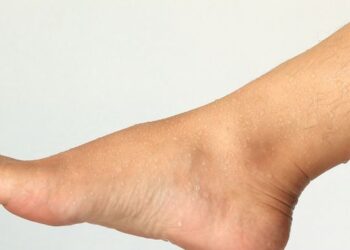 Waspadai Tanda-tanda Kolesterol Tinggi Bisa Anda Lihat dari Kaki