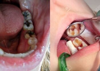 Cara Mencegah Gigi Berlubang: Langkah-langkah Sederhana