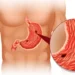 Maag: Bisakah Sembuh atau Hanya Bisa Dikendalikan?
