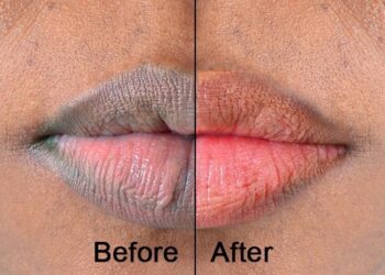 Cara Mencegah dan Mengatasi Bibir Hitam