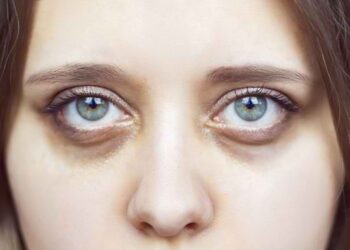 Mata Panda: Penyebab dan Cara Mengatasinya