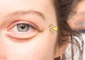 Cara Cepat Menghilangkan Kantong Mata: Panduan Lengkap