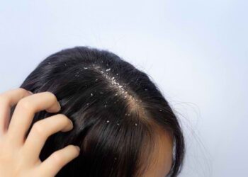 Atasi Ketombe dan Dapatkan Rambut Sehat Berkilau