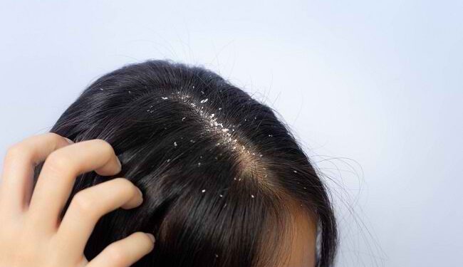 Atasi Ketombe dan Dapatkan Rambut Sehat Berkilau