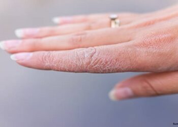 Kulit Lembap dan Tubuh Segar: Panduan Merawat Kulit Kering