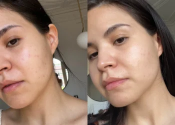 Niacinamide: Si Ajaib Pencerah Kulit