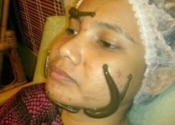 Terapi Lintah untuk Jerawat: Mitos atau Fakta?