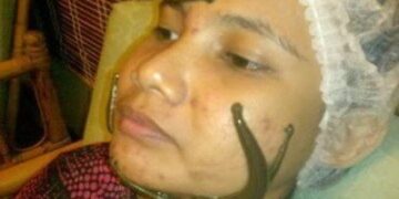 Terapi Lintah untuk Jerawat: Mitos atau Fakta?